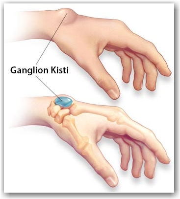 ganglion kisti nedir nasil tedavi edilir