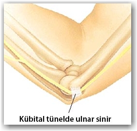 kubital tunel sendromu