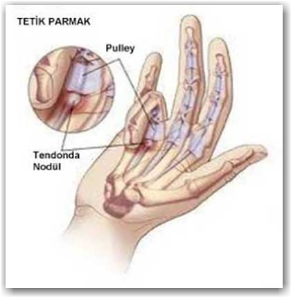 rheumatoid arthritis a kézben