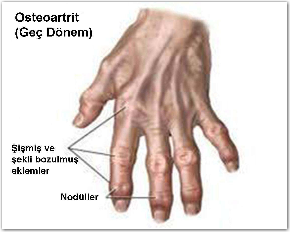 basparmak taban eklemi osteoartriti