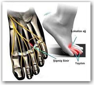 mortons neuroma