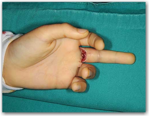 Fleksör tendon yırtılması