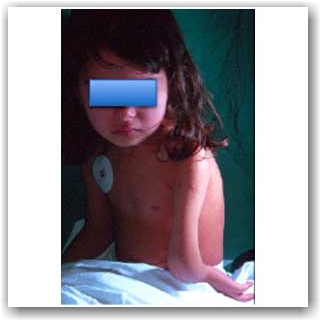 ulnar carpik el