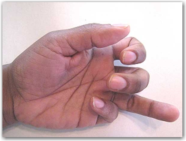 fleksör tendon yırtılmaları
