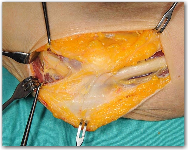 kubital-tunel-sendromu-ulnar-sinir-tedavisi