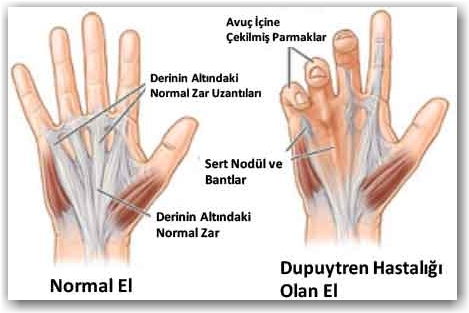 Dupuytren hastalığı
